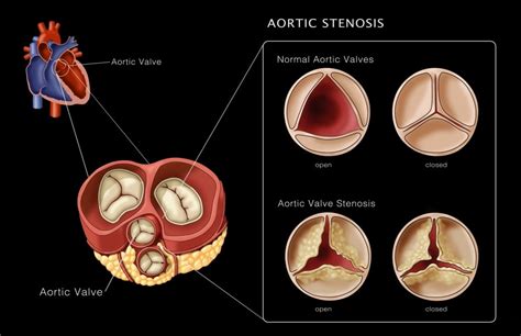 Aortic Valves Normal And Stenosis Illustration Poster Print By Monica Schroeder Science Source