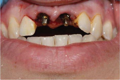 Immediate Implant Placement After Tooth Extractions A The Photo Of