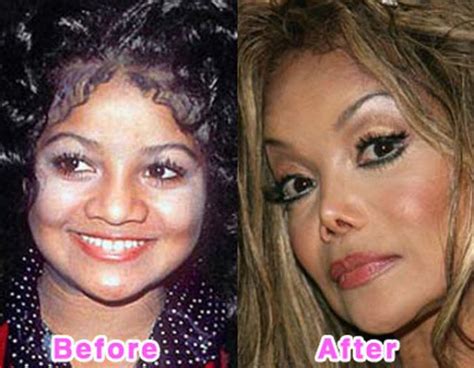 Celebrity Plastic Surgery Before And After Photos 16 Pics