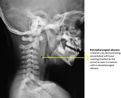 Retropharyngeal Abscess X Ray