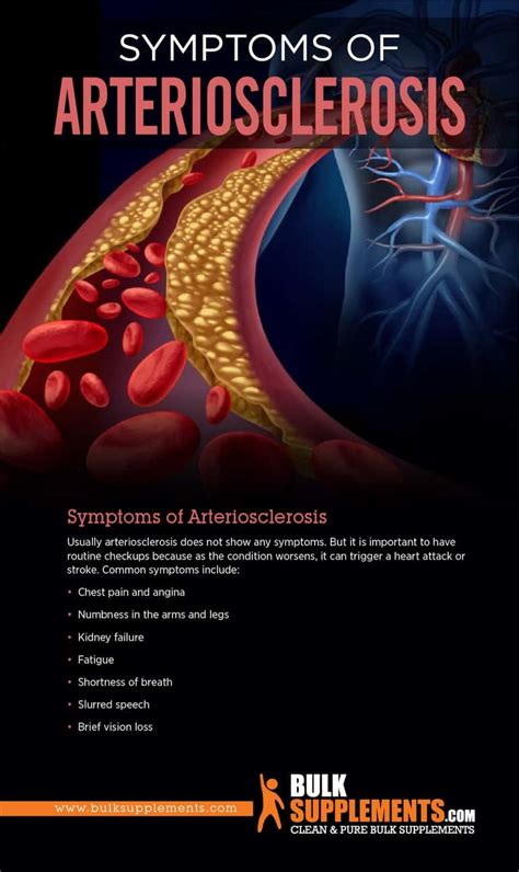 Arteriosclerosis Symptoms Causes And Treatment By James Denlinger