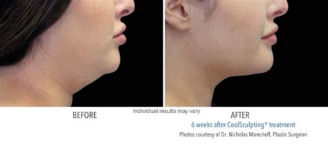 Coolsculpting Chin And Neck Fat Best Double Chin Reduction