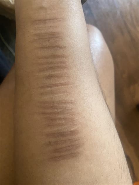More Of My Obsessively Neat Scars One Arm Is Controlled Compulsion