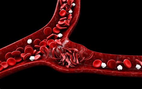 Sickle Cell Disease And Erectile Dysfunction Priapism Risk Canadian