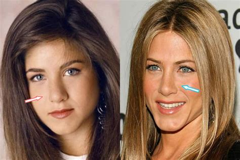 Has Jennifer Aniston Had Plastic Surgery Before And After 2018