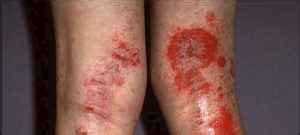 Dermatite Atópica Causas Sintomas e Como Prevenir