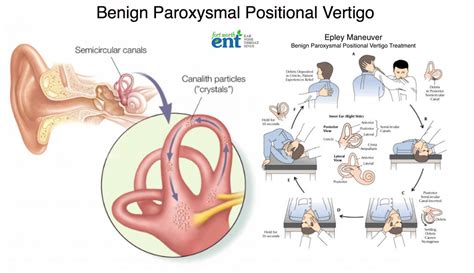 Benign Paroxysmal Positional Vertigo Epley Maneuver Xolerphilly