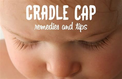 Best Ways To Get Rid Of Cradle Cap Cradle Cap Cradle Cap Remedies