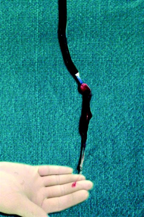 The catheter is then left in place for 12 to 24 hours while a steady infusion of medicine is delivered directly into the clot to help it dissolve. Use of a Flexible Cryoprobe for Removal of ...