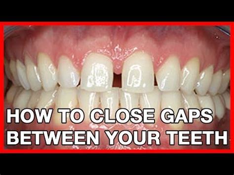 The basic principle is that you slip one teeth gap band * around your tooth gap and sleep the night away. Fixed My Teeth Gap Without Braces! 45MIN WORK! - YouTube ...
