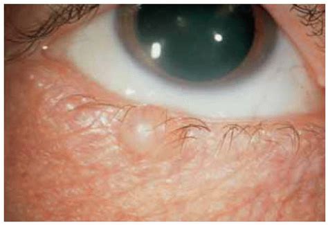 Sebaceous Cyst Eyelid
