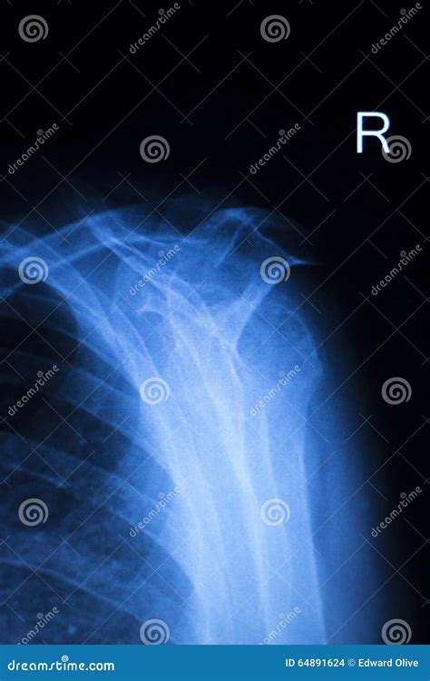 Shoulder Injury Orthopedics Xray Scan Stock Photo Image Of Joint