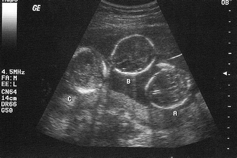 Identical Triplets Ultrasound