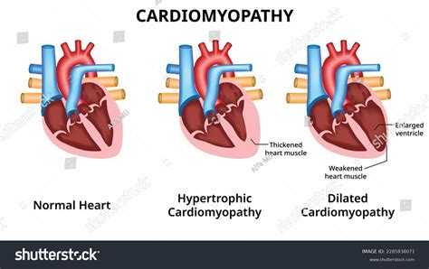 Types Heart Diseases Hypertrophic Cardiomyopathy Dilated Stock Vector