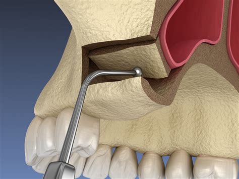 Sinus Lift Montville Oral Surgery