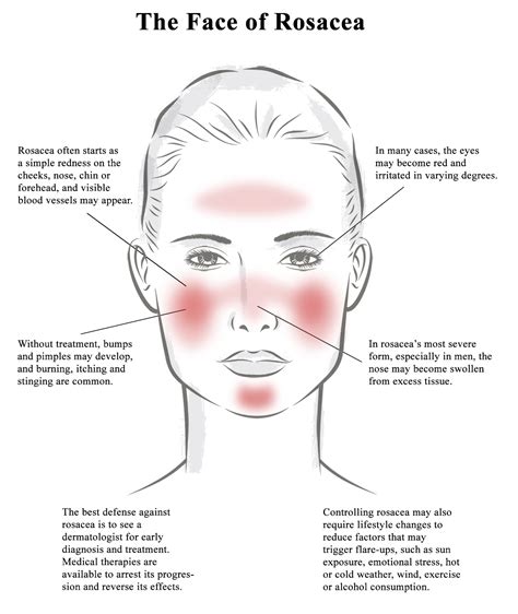 Rosacea Awareness Month Upstate Dermatology