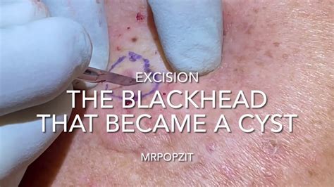 Ingrown Hair Cyst The Blackhead That Grew Up To Become A Cyst Cool