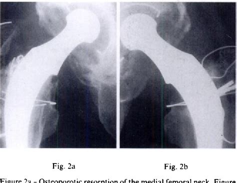 Figure 2 From Subsidence Of The Femoral Component Related To Long Term