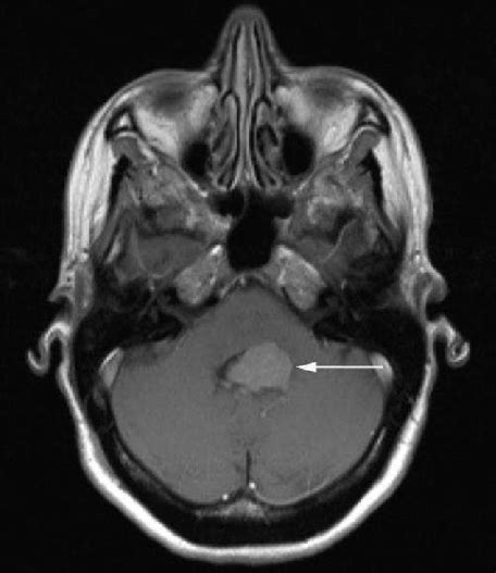 Image Of The Primary Tumor An Intraventricular Atypical Choroid Plexus