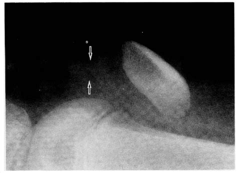 Figure 2 From Fracture Of The Patella In Children A Report Of Two Cases