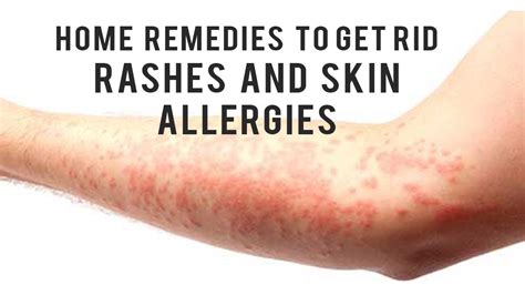 How To Treat A Skin Rash From An Allergic Reaction At Sarah Mora Blog