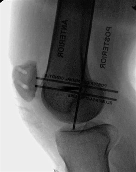 Medial Patellofemoral Ligament Reconstruction With A Looped