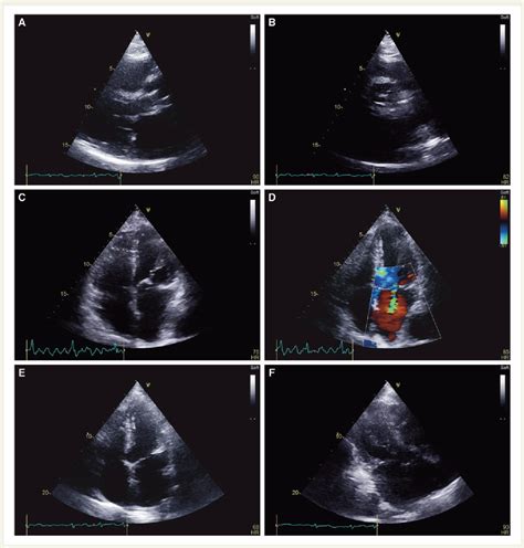 Figure 1 From Aortic Valve Endocarditis With Root Abscess Causing