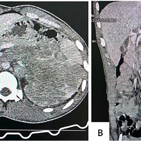 Axial Contrast Enhanced Ct Of Abdomen Demonstrating Large Download