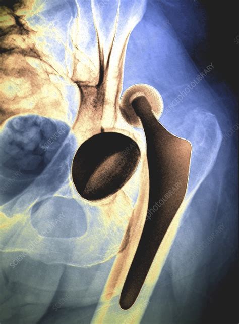 Dislocated Hip Replacement X Ray Stock Image C0489276 Science