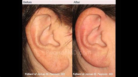 Earlobe Reduction Dr James Pearson Facial Plastic Surgery Youtube