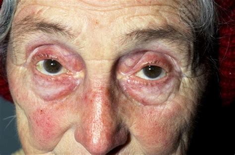 Cutaneous Manifestations Of Endocrine Disorders