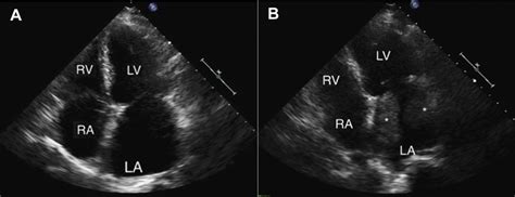 A Transthoracic Apical Four Chamber View Left From Echocardiography