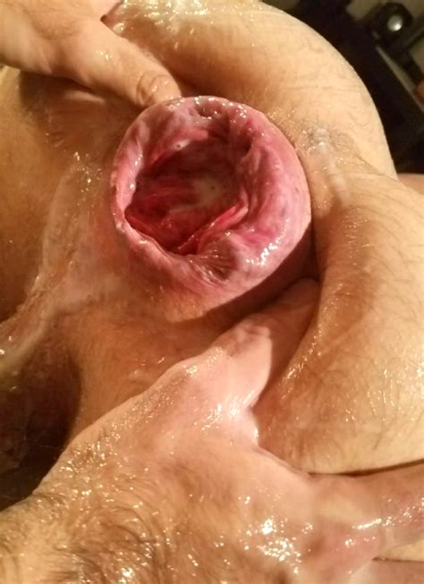 Gay Prolapse Sucking Search Xnxx Hot Sex Picture