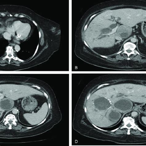 Ct Scan Showing Multiloculate Hydatid Cysts Of The Right Hepatic Lobe