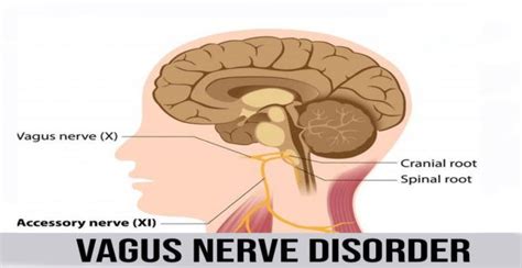 Vagus Nerve Disorder Nerve Disorders Parkinsons Disease Vagus Nerve
