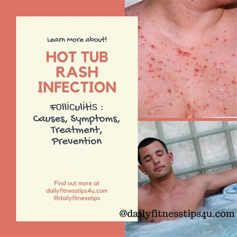 Fоllісulіtіѕ Hot Tub Rash Infection Causes Symptoms Treatment