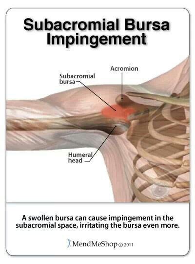 Subacromial Bursa Impingement Shoulder Impingement Surgery Shoulder
