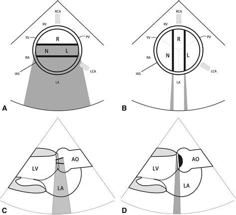 Orientation Of Bileaflet Mechanical Aortic Valve Prostheses For Optimal
