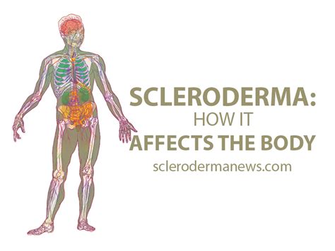A Look At The Different Types Of Scleroderma Systemic Sclerosis Artofit
