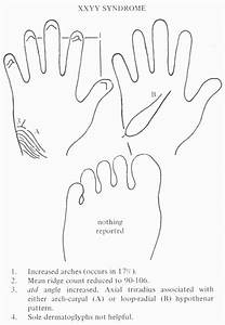 Hand Charts For Klinefelter Syndrome Xxy