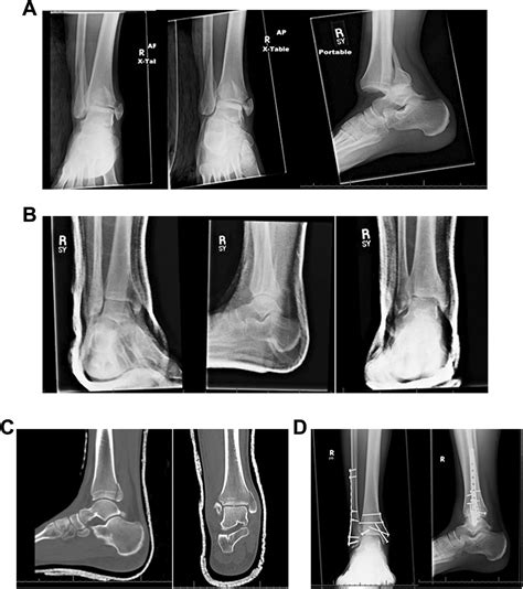Ankle Fractures And Dislocations Different Types Of I