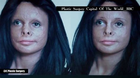 Bk Hospital Plastic Surgery Uk Bbc Documentary Bk Plastic Surgery