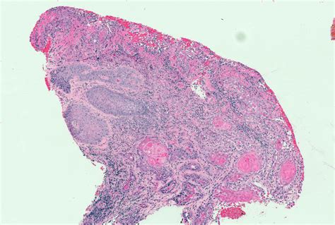 Pathology Outlines Hpv Associated Squamous Cell Carcinoma
