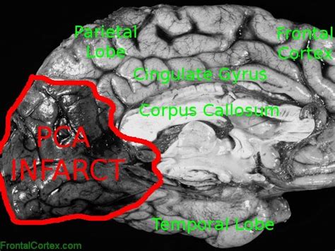 Posterior Cerebral Artery Infarct Mid Sagittal Section Of Cerebral