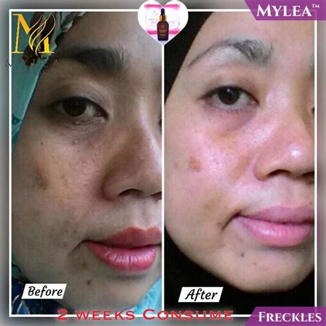 * 2 serum iaitu glowing serum (day) & lifthing serum (night). Miss DeL: MYLEA FRECKLES SERUM