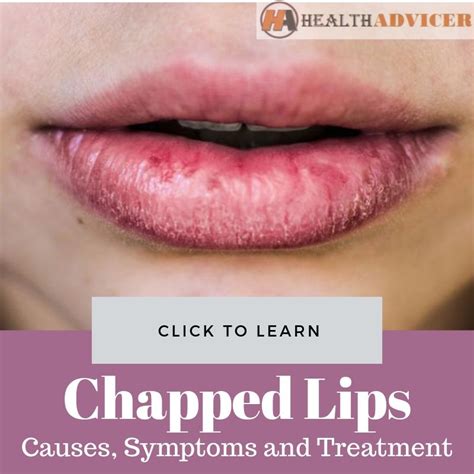 Chapped Lips Causes Picture Symptoms And Treatment