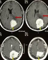 Images of After Brain Tumour Surgery Side Effects