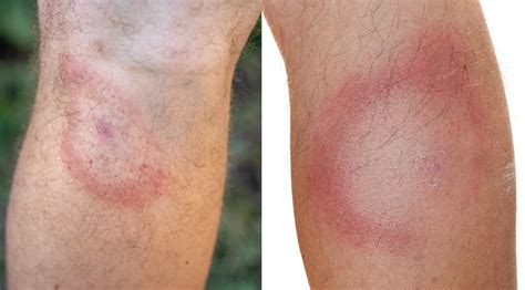 Tick Bite Symptoms What To Watch For Field And Stream