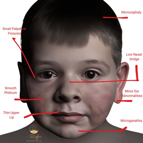 Fetal Alcohol Syndrome Understanding Its Causes Symptoms And Prevention The Ridge Ohio