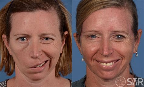 Lower Eyelid Tarsal Strip Or Canthoplasty Before And After Photo